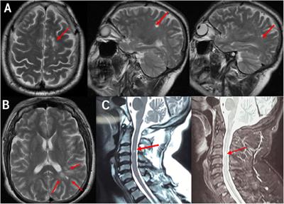 A Patient With Multiple Sclerosis and Coexisting Moyamoya Disease: Why and How